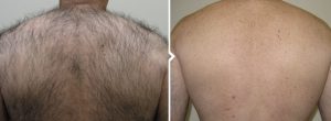 Man's back before and after laser hair removal in Glasgow